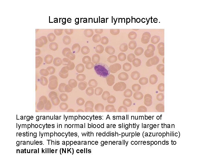 Large granular lymphocyte. Large granular lymphocytes: A small number of lymphocytes in normal blood