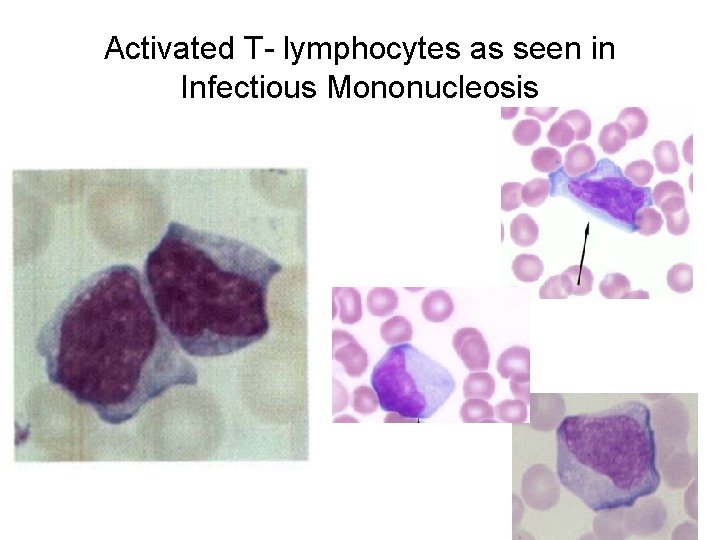 Activated T- lymphocytes as seen in Infectious Mononucleosis 