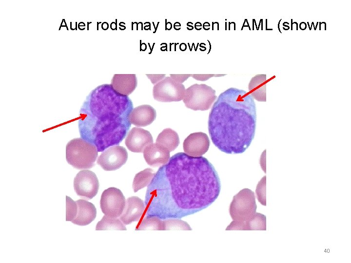 Auer rods may be seen in AML (shown by arrows) 40 