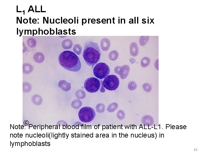 L 1 ALL Note: Nucleoli present in all six lymphoblasts Note: Peripheral blood film