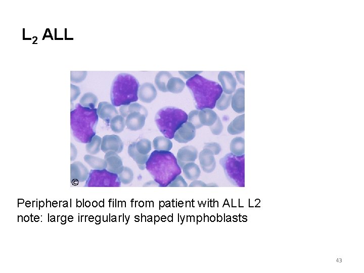 L 2 ALL Peripheral blood film from patient with ALL L 2 note: large