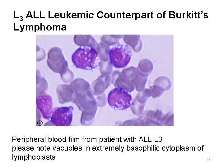 L 3 ALL Leukemic Counterpart of Burkitt’s Lymphoma Peripheral blood film from patient with