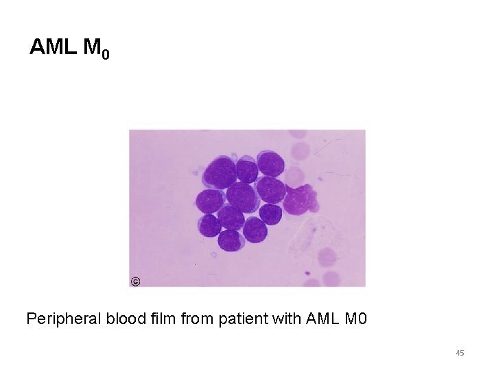 AML M 0 Peripheral blood film from patient with AML M 0 45 