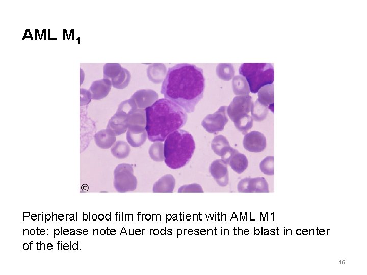 AML M 1 Peripheral blood film from patient with AML M 1 note: please