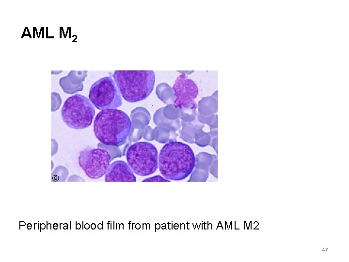 AML M 2 Peripheral blood film from patient with AML M 2 47 