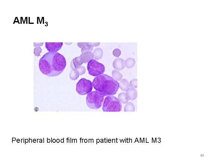 AML M 3 Peripheral blood film from patient with AML M 3 48 