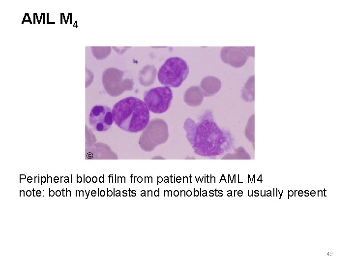 AML M 4 Peripheral blood film from patient with AML M 4 note: both