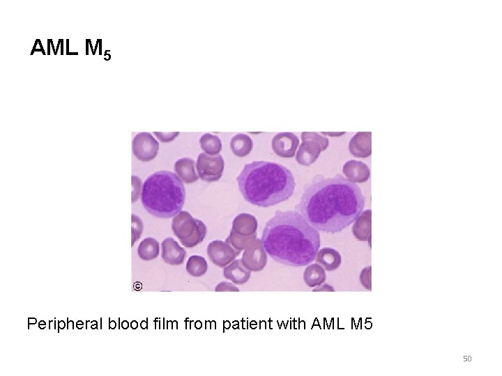 AML M 5 Peripheral blood film from patient with AML M 5 50 