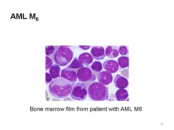 AML M 6 Bone marrow film from patient with AML M 6 51 
