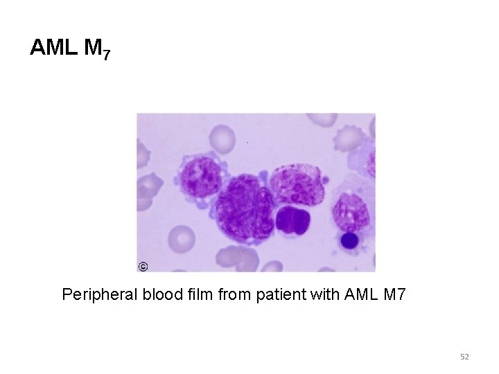 AML M 7 Peripheral blood film from patient with AML M 7 52 