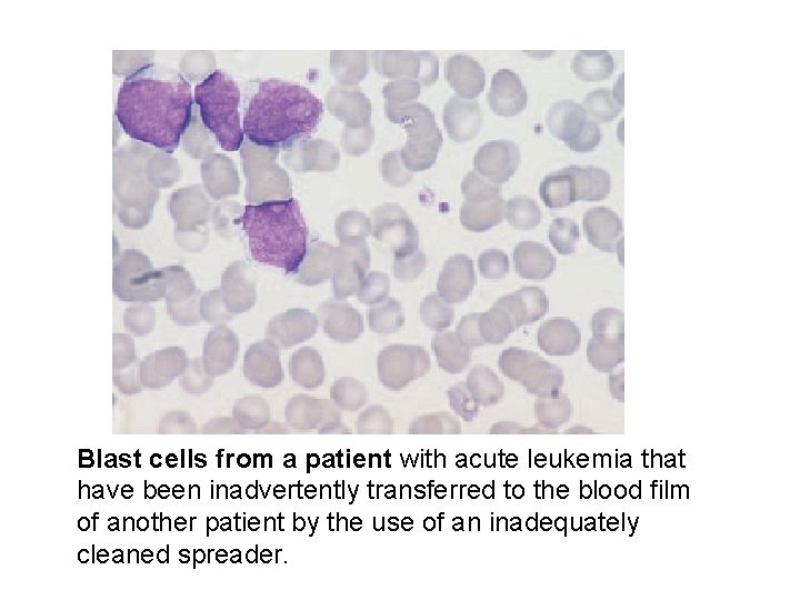 Blast cells from a patient with acute leukemia that have been inadvertently transferred to