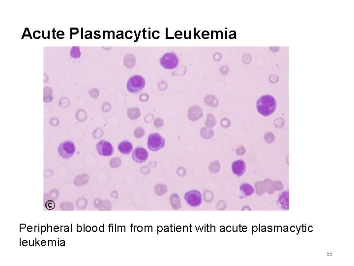 Acute Plasmacytic Leukemia Peripheral blood film from patient with acute plasmacytic leukemia 55 