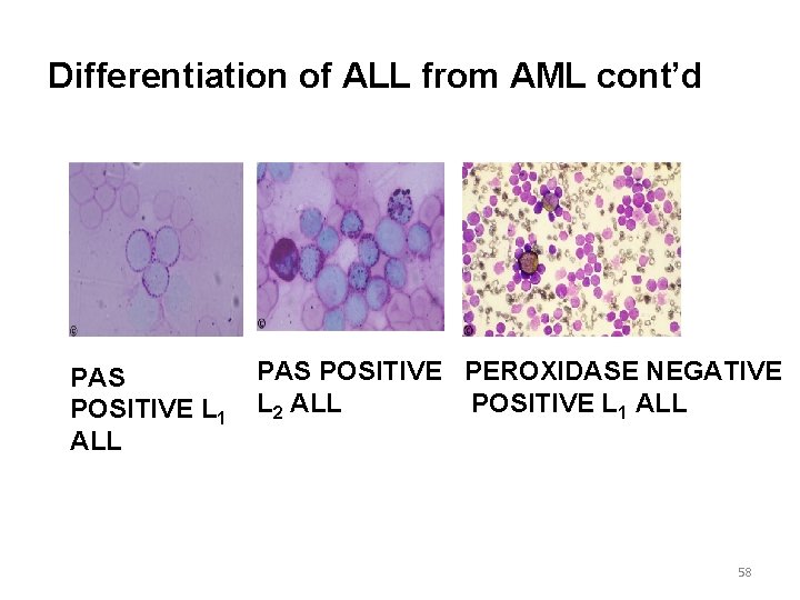 Differentiation of ALL from AML cont’d PAS POSITIVE L 1 ALL PAS POSITIVE PEROXIDASE