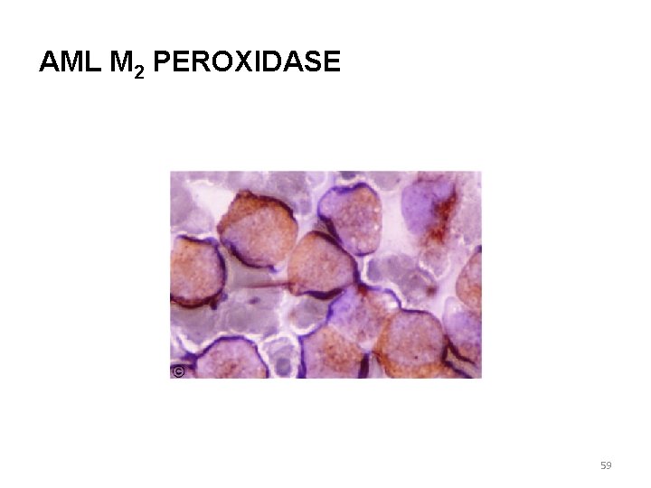 AML M 2 PEROXIDASE 59 