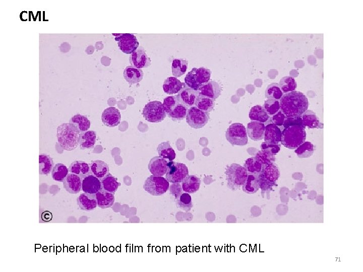 CML Peripheral blood film from patient with CML 71 