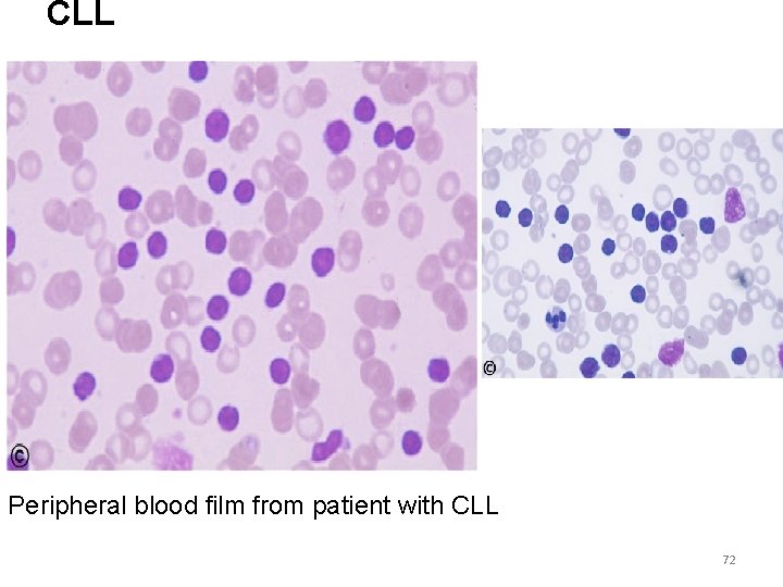CLL Peripheral blood film from patient with CLL 72 