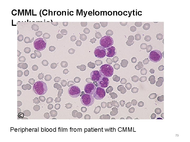 CMML (Chronic Myelomonocytic Leukemia) Peripheral blood film from patient with CMML 73 