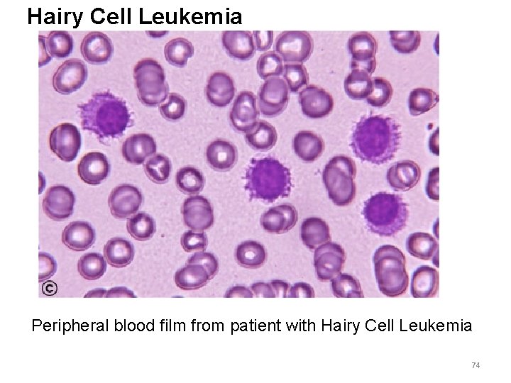 Hairy Cell Leukemia Peripheral blood film from patient with Hairy Cell Leukemia 74 