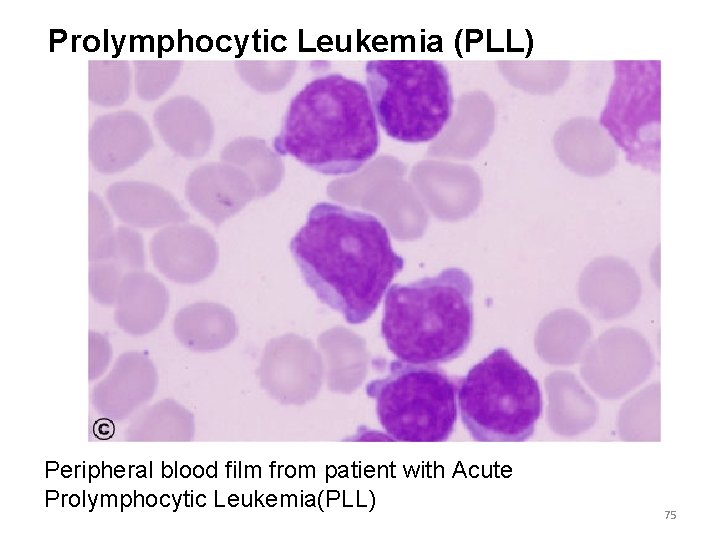 Prolymphocytic Leukemia (PLL) Peripheral blood film from patient with Acute Prolymphocytic Leukemia(PLL) 75 