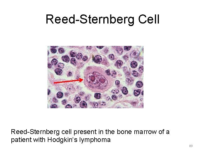 Reed-Sternberg Cell Reed-Sternberg cell present in the bone marrow of a patient with Hodgkin’s