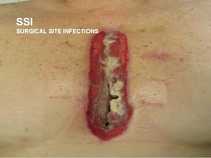 SSI SURGICAL SITE INFECTIONS 