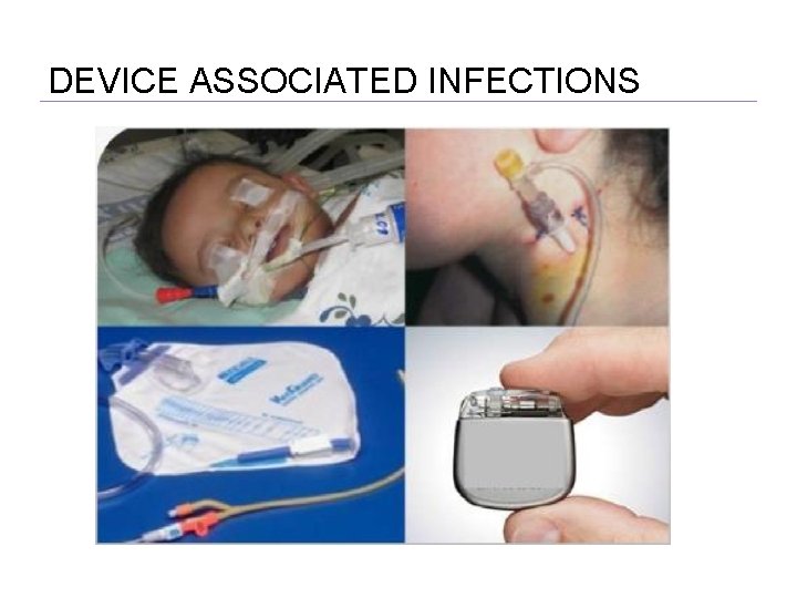 DEVICE ASSOCIATED INFECTIONS 