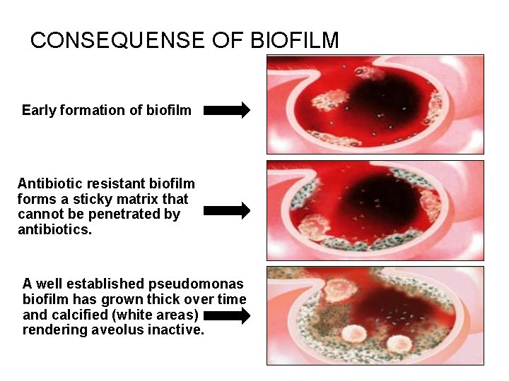 CONSEQUENSE OF BIOFILM Early formation of biofilm Antibiotic resistant biofilm forms a sticky matrix
