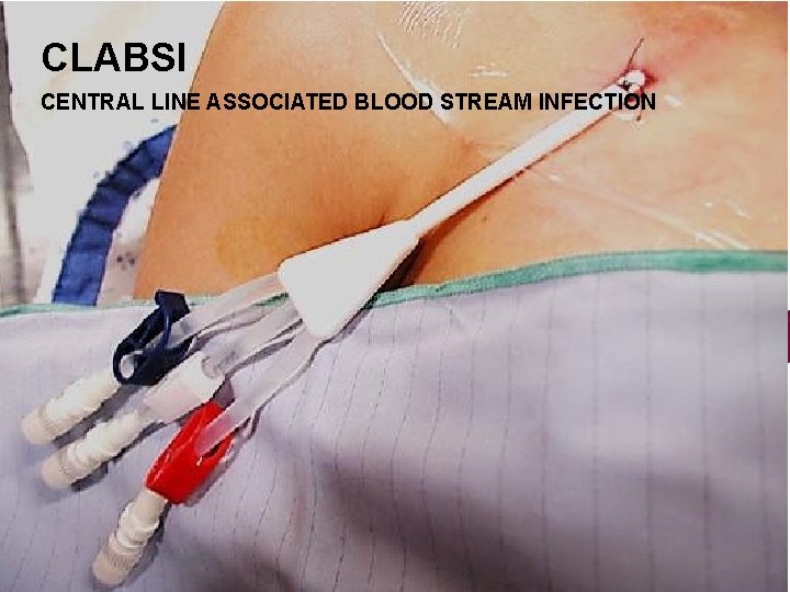 CLABSI CENTRAL LINE ASSOCIATED BLOOD STREAM INFECTION 