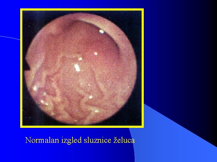 Normalan izgled sluznice želuca 