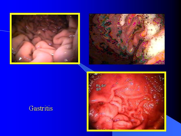 Gastritis 