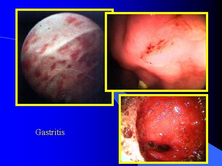 Gastritis 