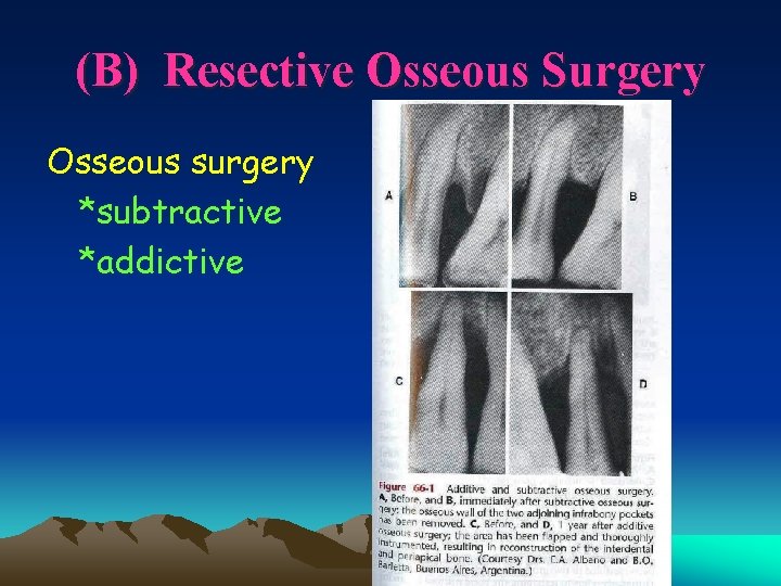 (B) Resective Osseous Surgery Osseous surgery *subtractive *addictive 