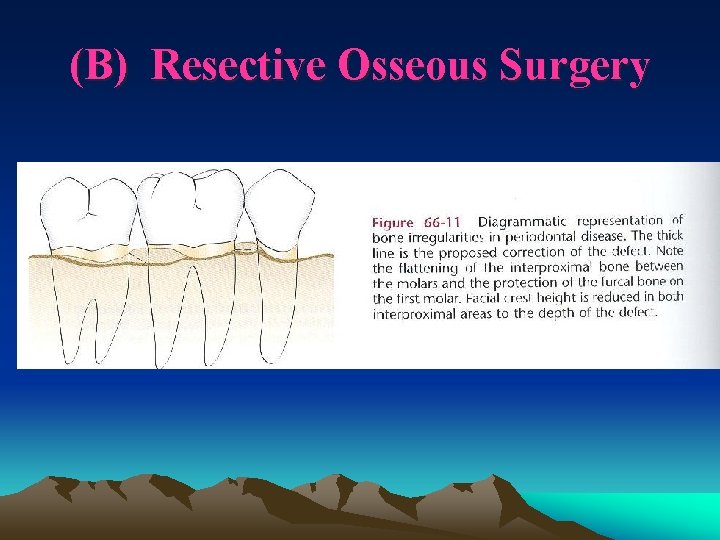 (B) Resective Osseous Surgery 