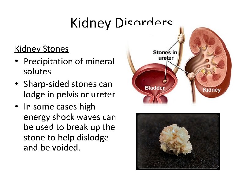 Kidney Disorders Kidney Stones • Precipitation of mineral solutes • Sharp-sided stones can lodge