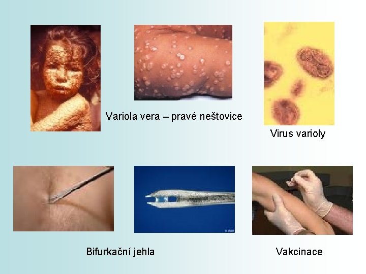 Variola vera – pravé neštovice Virus varioly Bifurkační jehla Vakcinace 