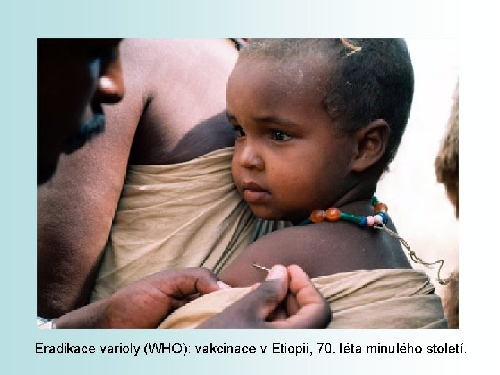 Eradikace varioly (WHO): vakcinace v Etiopii, 70. léta minulého století. 