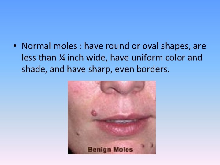  • Normal moles : have round or oval shapes, are less than ¼