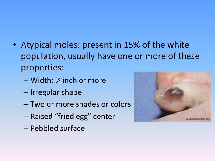  • Atypical moles: present in 15% of the white population, usually have one