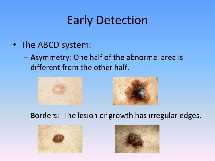 Early Detection • The ABCD system: – Asymmetry: One half of the abnormal area