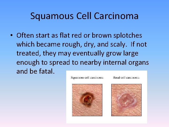 Squamous Cell Carcinoma • Often start as flat red or brown splotches which became