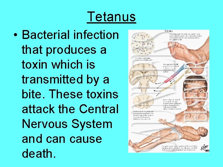 Tetanus • Bacterial infection that produces a toxin which is transmitted by a bite.