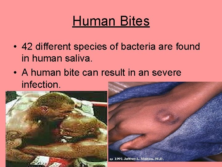 Human Bites • 42 different species of bacteria are found in human saliva. •