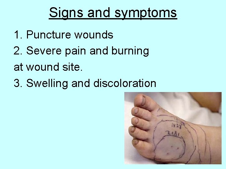 Signs and symptoms 1. Puncture wounds 2. Severe pain and burning at wound site.