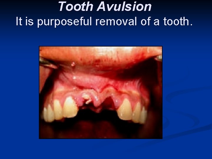 Tooth Avulsion It is purposeful removal of a tooth. 
