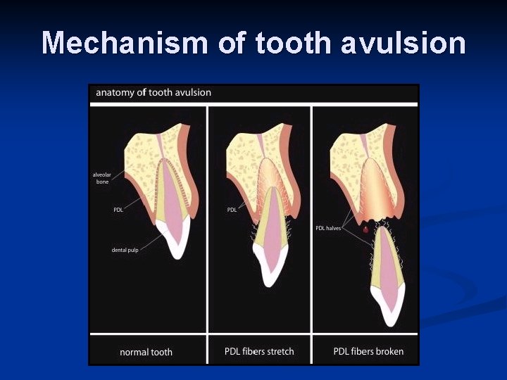 Mechanism of tooth avulsion 