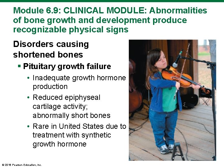 Module 6. 9: CLINICAL MODULE: Abnormalities of bone growth and development produce recognizable physical