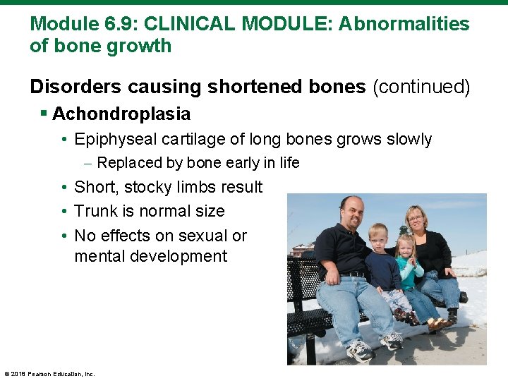 Module 6. 9: CLINICAL MODULE: Abnormalities of bone growth Disorders causing shortened bones (continued)