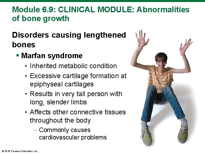 Module 6. 9: CLINICAL MODULE: Abnormalities of bone growth Disorders causing lengthened bones §