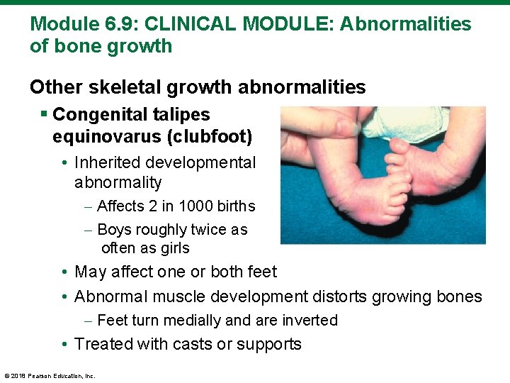 Module 6. 9: CLINICAL MODULE: Abnormalities of bone growth Other skeletal growth abnormalities §