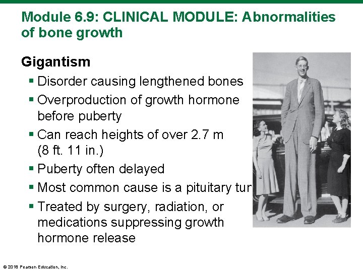 Module 6. 9: CLINICAL MODULE: Abnormalities of bone growth Gigantism § Disorder causing lengthened